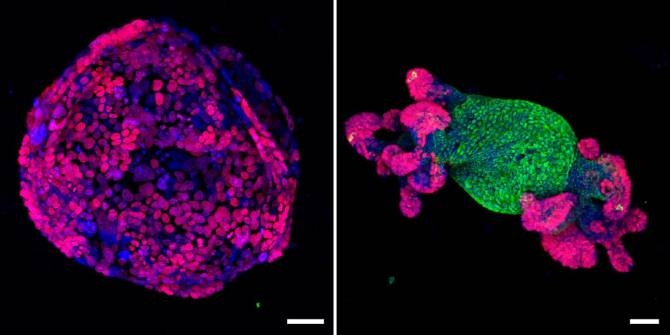 Un gen capaz de revertir a su estado sano a células cancerosas en ciertos tumores