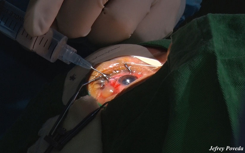 Más nicaragüenses recuperan la vista en jornada quirúrgica en el Centro Nacional de Oftalmología