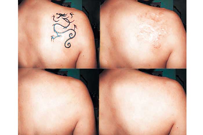 ¿Se pueden quitar los tatuajes sin lesionar la piel?